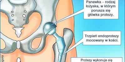 Co to jest endoproteza stawu biodrowego ? 